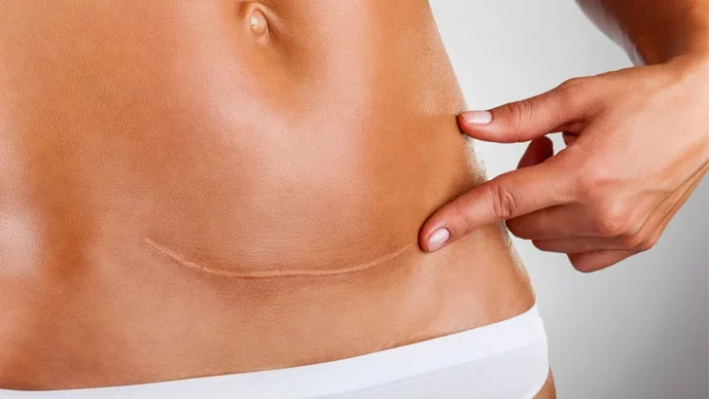 Fluid accumulation after abdominoplasty