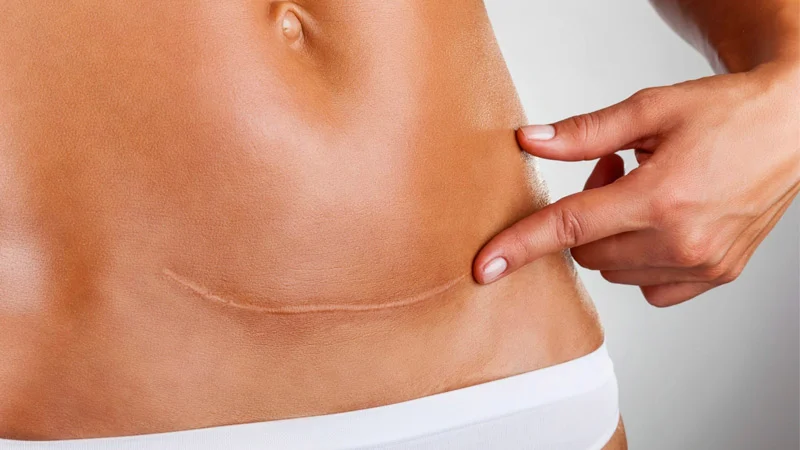 Fluid accumulation after abdominoplasty