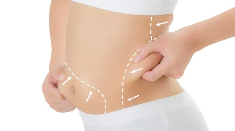Complications after lipomatic surgery