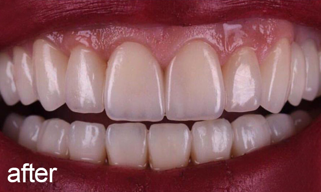 Regret of dental laminate