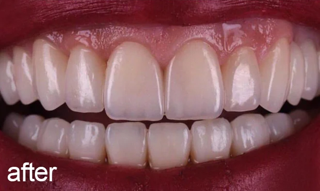Advantages of dental laminates