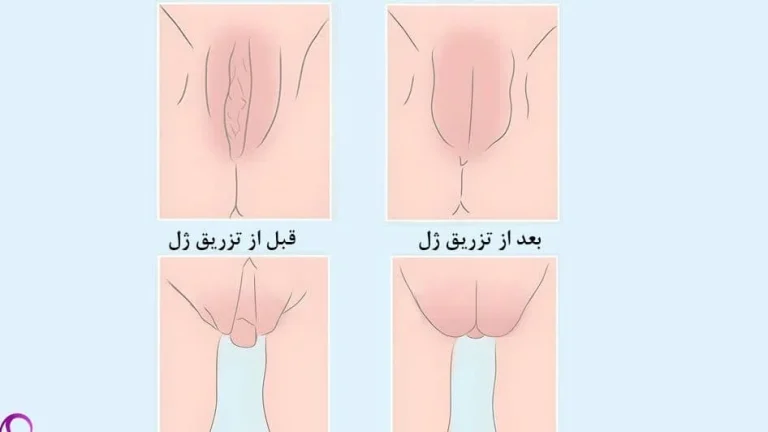 علائم عفونت بعد از تزریق چربی به واژن چیست؟