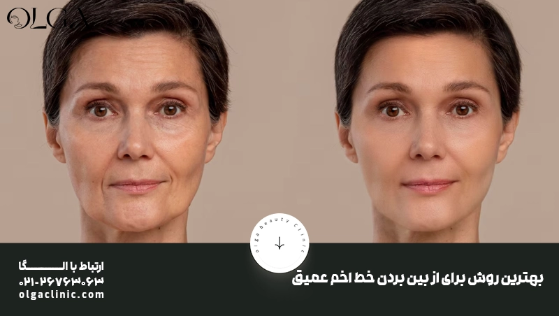 بهترین روش برای از بین بردن خط اخم عمیق